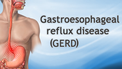 Gastric Reflux Disease